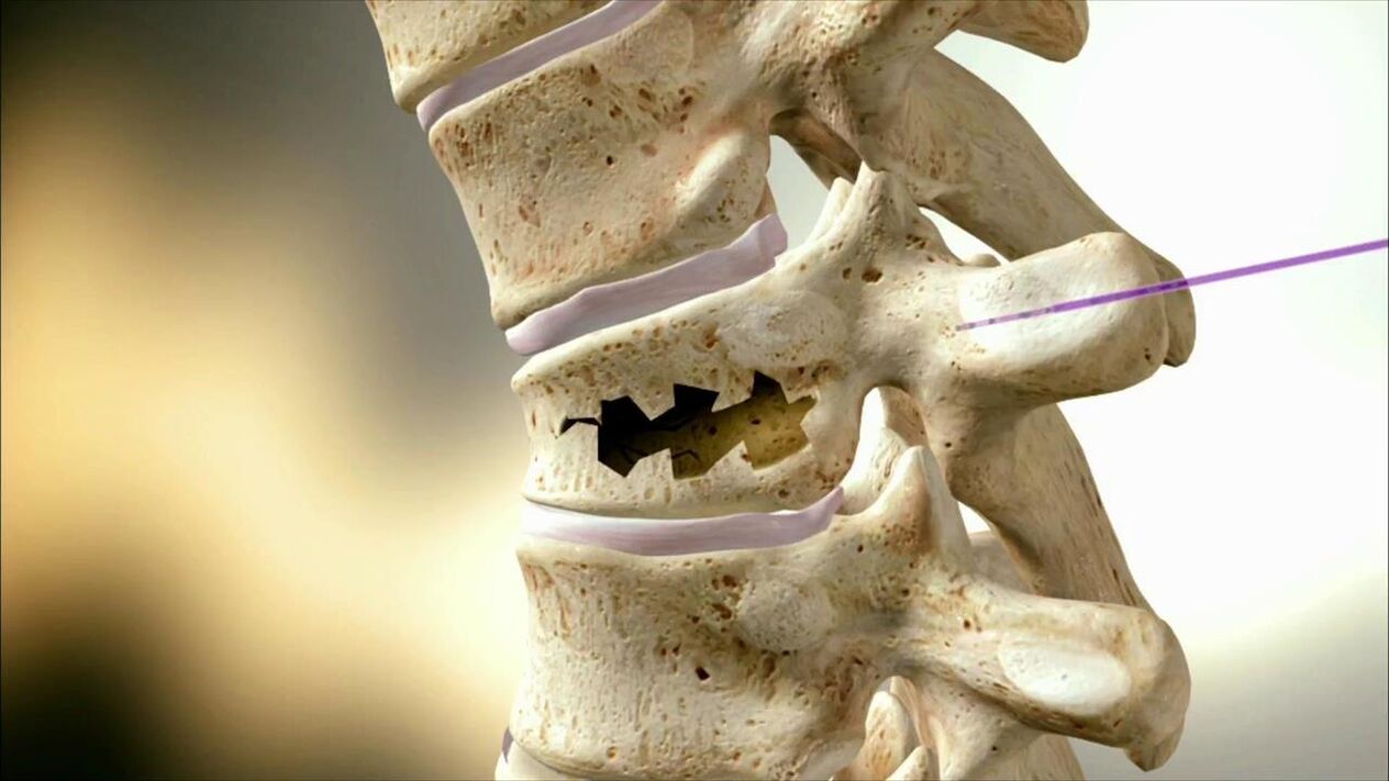 Spinal disk damage