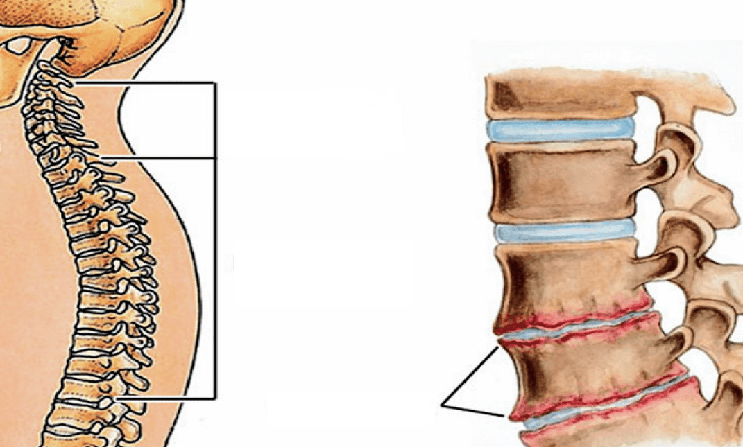 What has the bone cartilage in the spine become