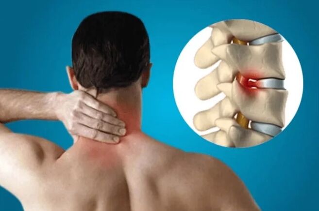 Osteochondral disease of the spine