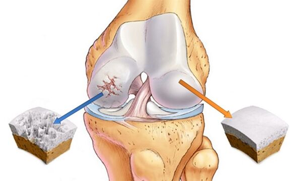 Healthy Cartilage and Cartilage Affected by Arthropathy