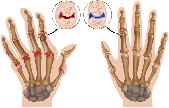 Joints causing deformation of fingers