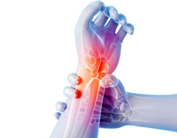 Arthritis of the joints is accompanied by pain and requires complex treatment