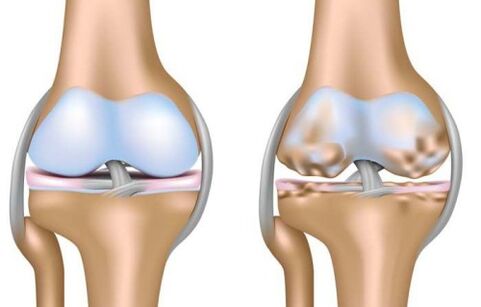 Healthy Joints and Knee Destruction Caused by Joints