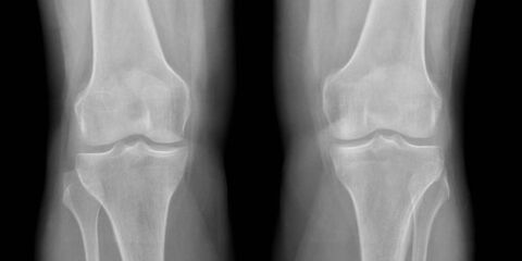 Knee joint on x-ray