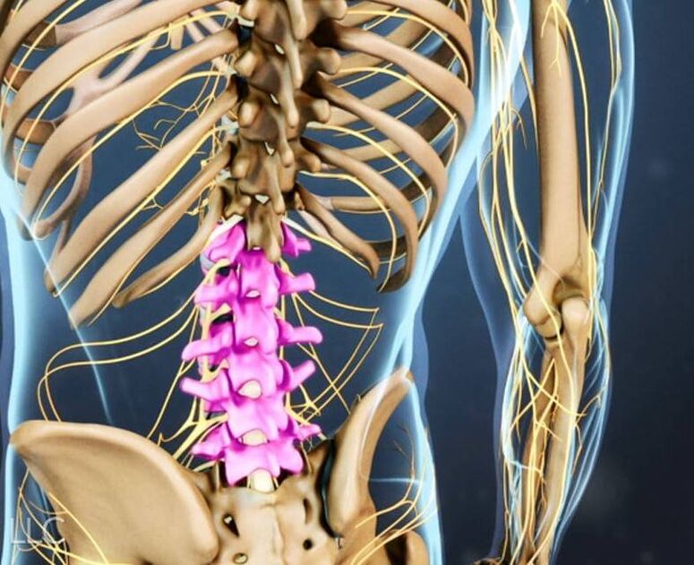 Lumbar osteochondrosis