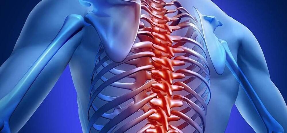 Thoracic osteochondrosis