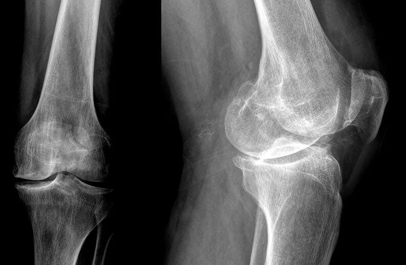 Diagnosis of joint disease