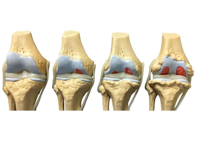 degree of arthritis in the joint